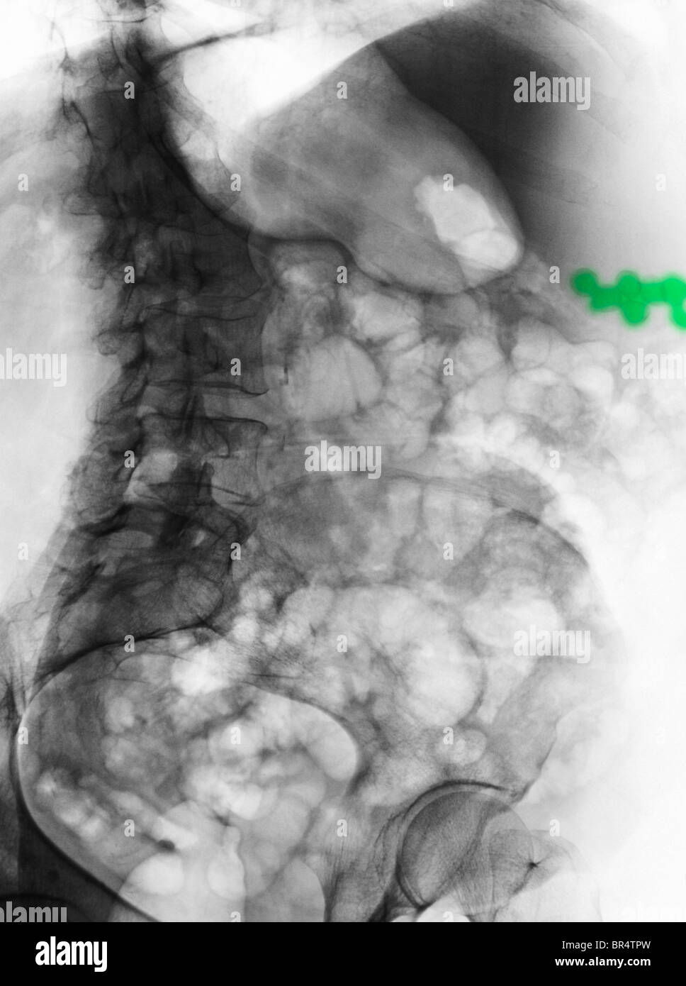 Abdomen radiographie d'un femme de 59 ans avec des calculs biliaires Banque D'Images