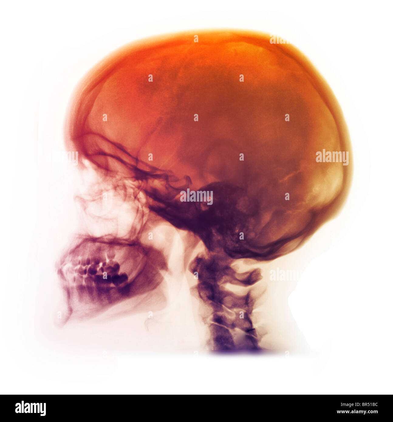 Radiographie latérale du crâne d'une femme de 42 ans, crâne normal x-ray d'une femme de 42 ans Banque D'Images