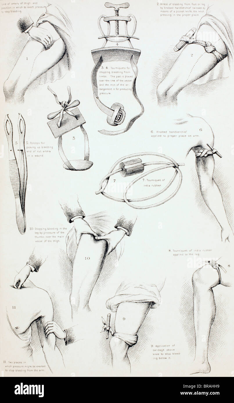 Méthodes d'arrêter les saignements. À partir de la famille Médecin, publié vers 1890. Banque D'Images