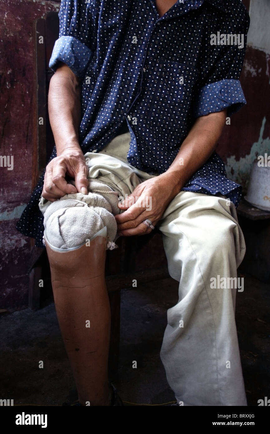 Une UXO victime montre sa jambe artificielle dans sa chambre d'hôpital au Centre national de réhabilitation à Vientiane au Laos. Banque D'Images