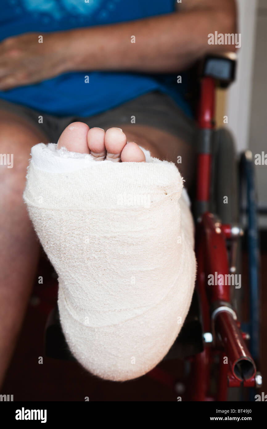 Sur pied d'une femme avec les os de la cheville cassée situé dans un 'Back' Dalle plâtre-cast. Banque D'Images