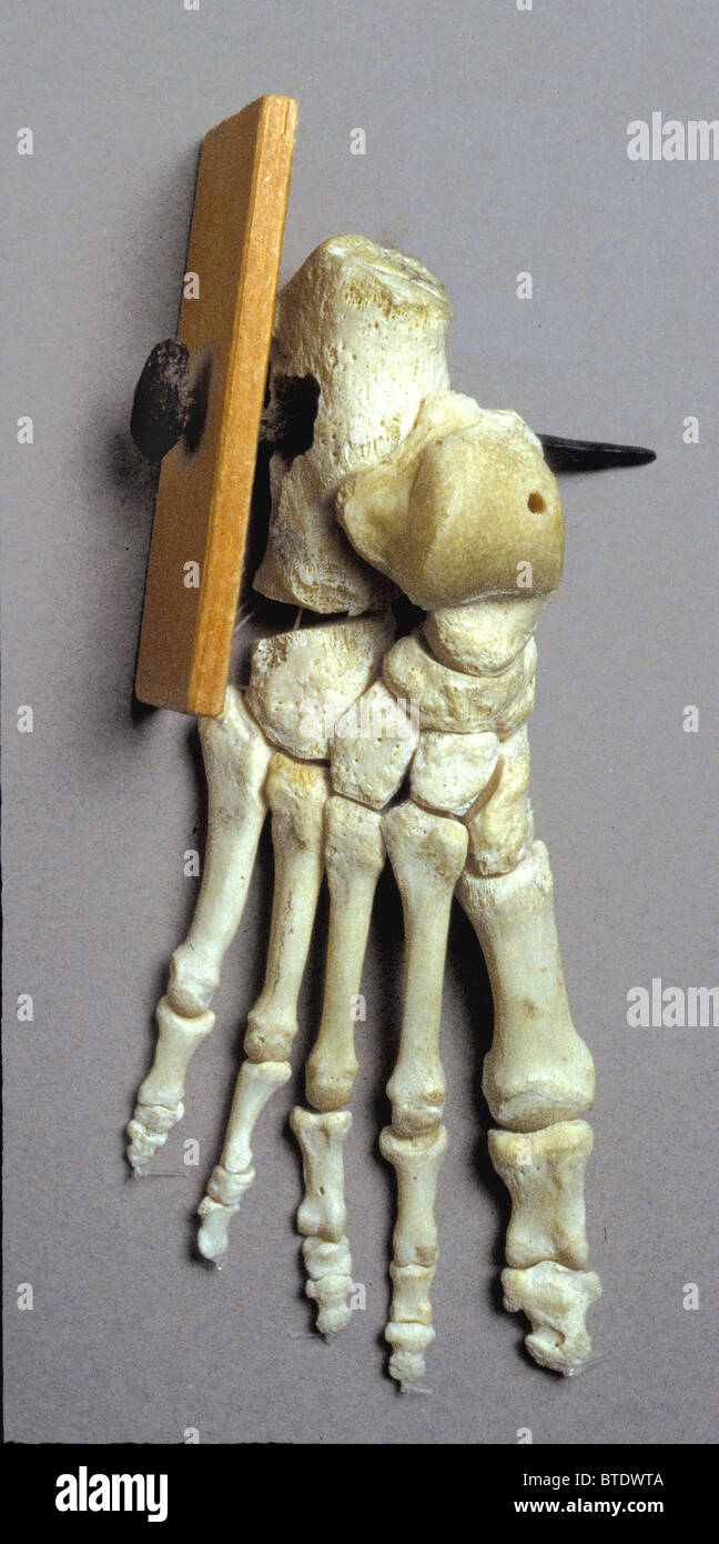 5202. Modèle d'un squelette avec un piercing d'ongle de pied LE HEELBONE CRUCIFIXIO Romain, représentant Banque D'Images