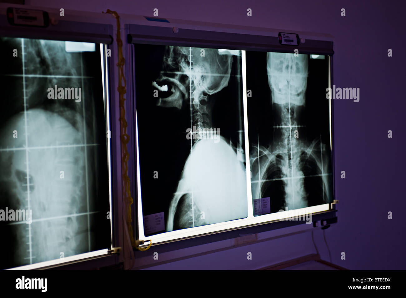 X-ray de la tête et du cou Banque D'Images