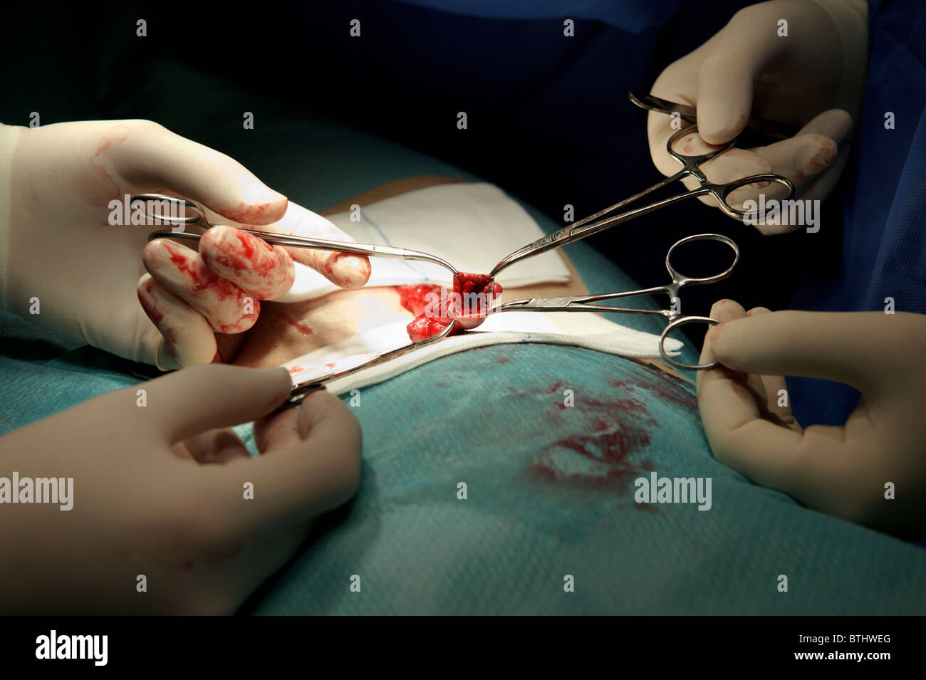 Tumeurs du testicule, de l'urologie chirurgie de déplacement Banque D'Images