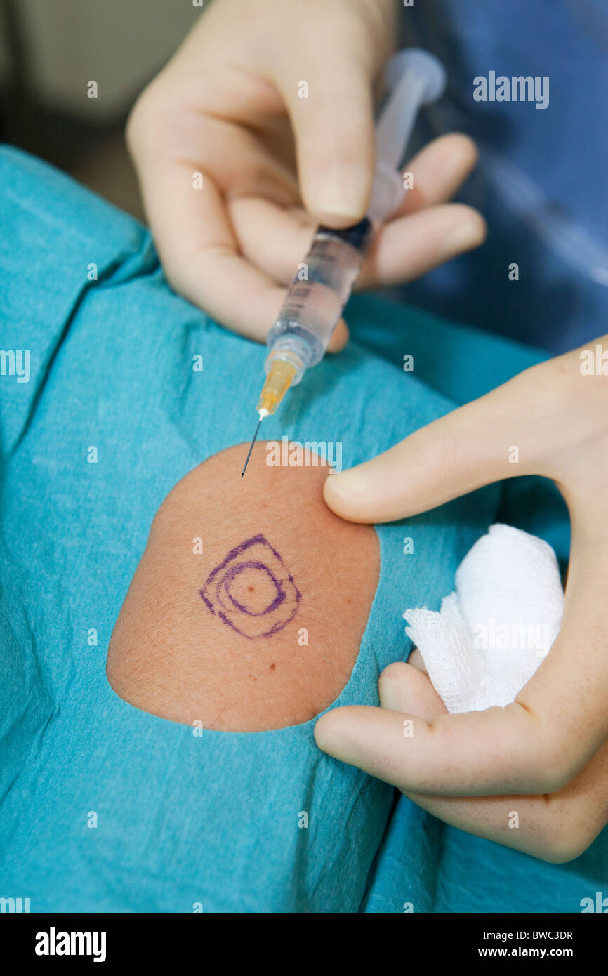 En préparation d'une injection de biopsies de cancer de la peau Banque D'Images