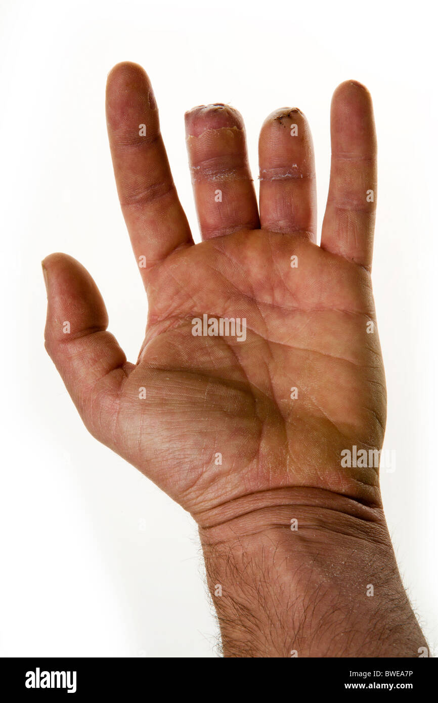 Homme close up of main gauche sur fond blanc deux doigts manquants Photo  Stock - Alamy