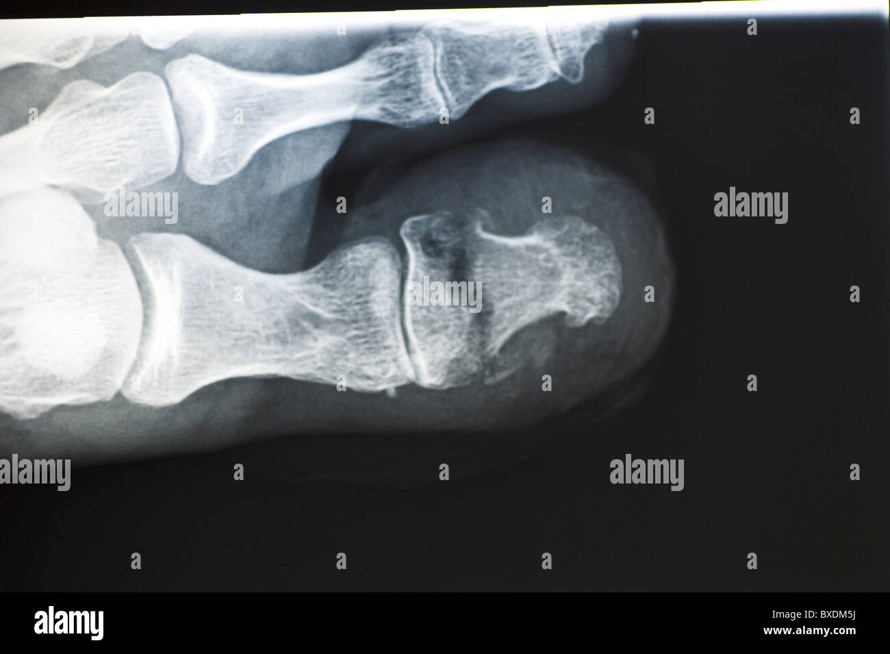 Orteil cassé X Ray Banque D'Images