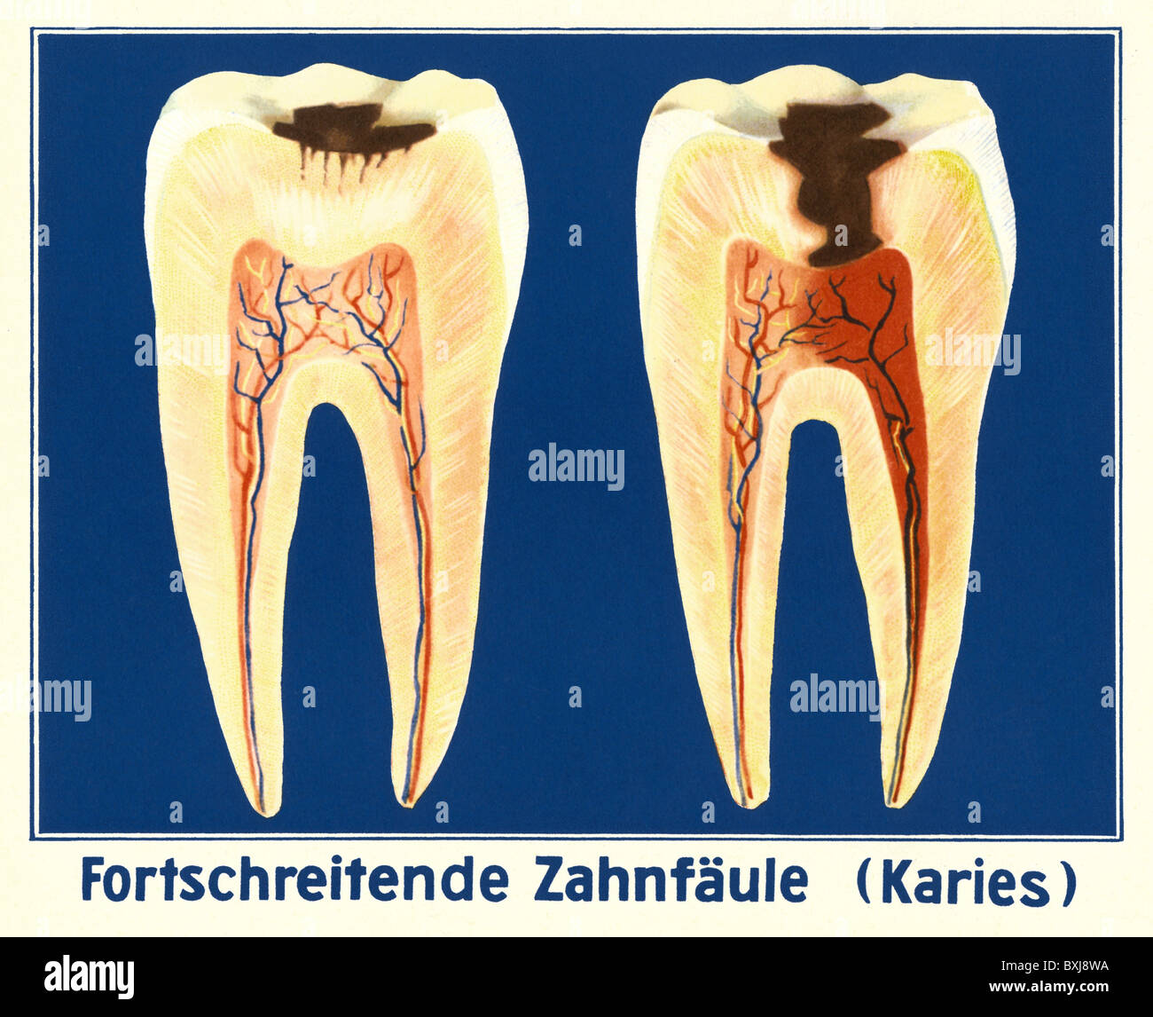 Médecine, dentisterie, carie dentaire, carte scolaire, Allemagne, vers 1935, droits additionnels-Clearences-non disponible Banque D'Images