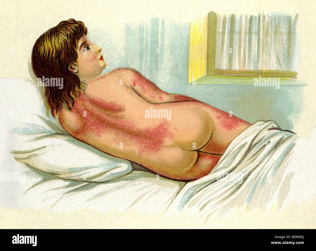 Médecine, maladies pandémiques, fièvre des cicatrices, enfant couché au lit, lithographie, Allemagne, vers 1903, droits additionnels-Clearences-non disponible Banque D'Images