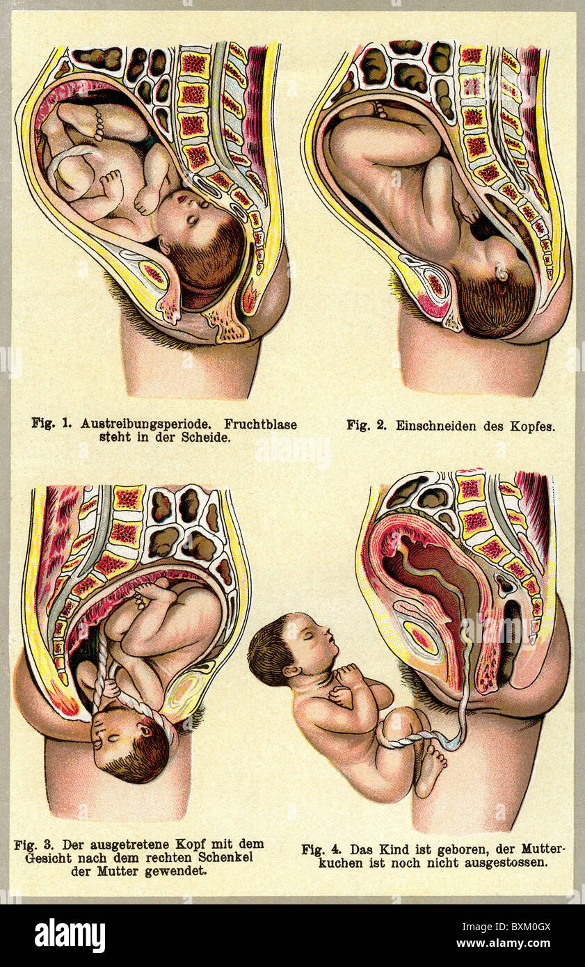 Médecine, gynécologie, naissance, phases, lithographie, Allemagne, vers 1905, droits additionnels-Clearences-non disponible Banque D'Images
