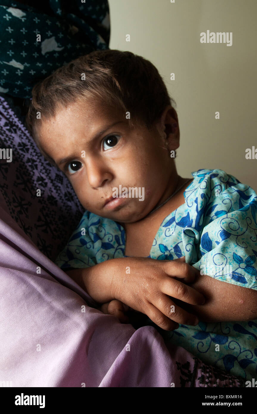 Le Pakistan après le déluge. Les médecins dans le monde clinique. Naseema Beroyi,la fille de 2 ans l'Asifa a la gale. Banque D'Images