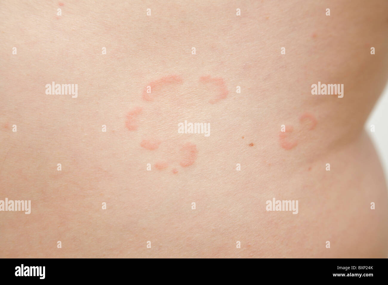 Psoriasis doux sur la peau sur le côté de l'abdomen Banque D'Images