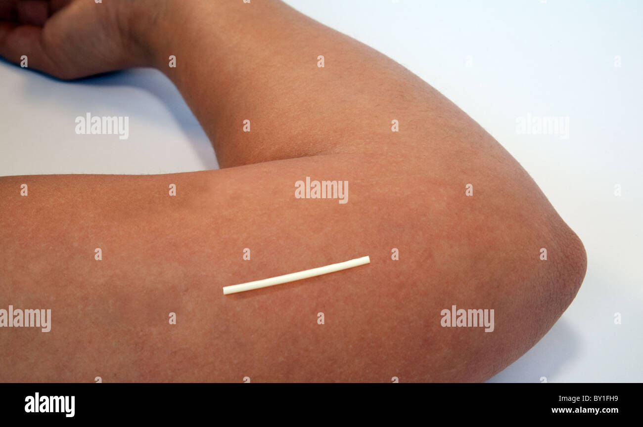 Un implant de progestérone Nexplanon assis sur une jeune femme près de bras le coude dans la position où il serait inséré Banque D'Images