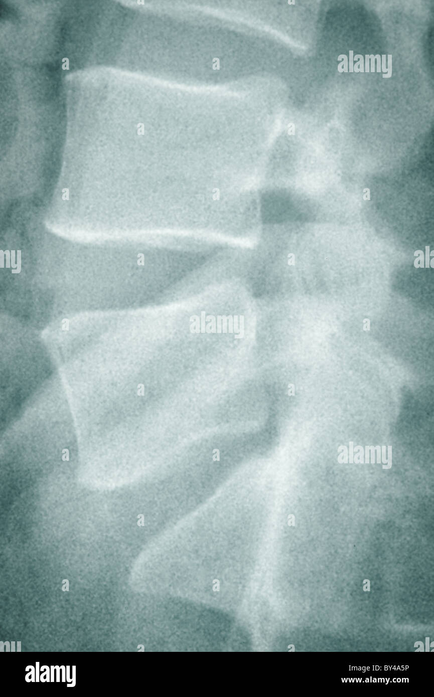 Radiographie du thorax : arrière Banque D'Images