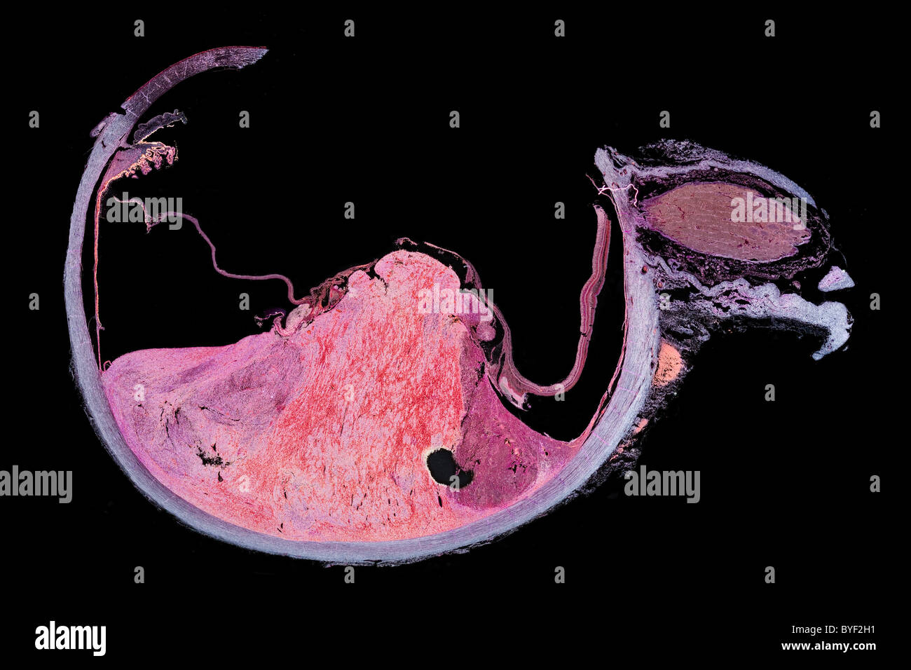 Darkfield photomicrographie, œil humain section avec tumeur melanotic Banque D'Images