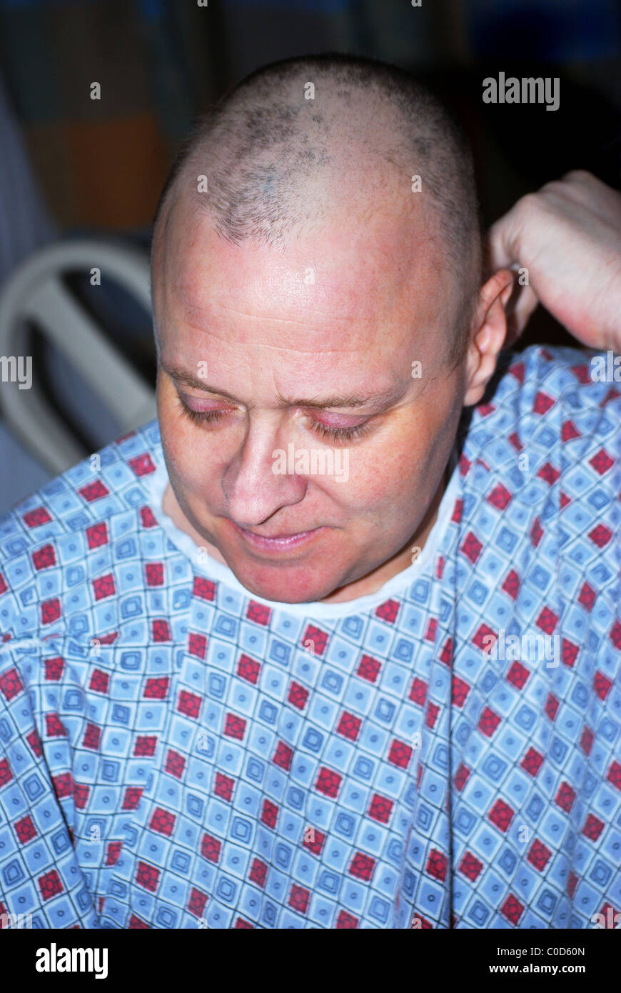 Homme cancer patient affiche la perte de cheveux après la chimiothérapie. Banque D'Images