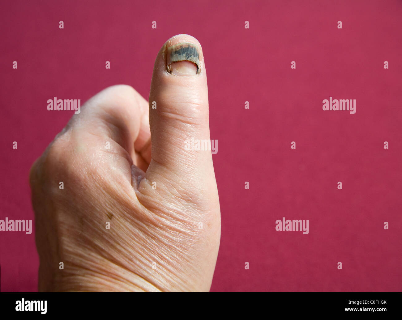 Damaged nail Banque de photographies et d'images à haute résolution - Alamy