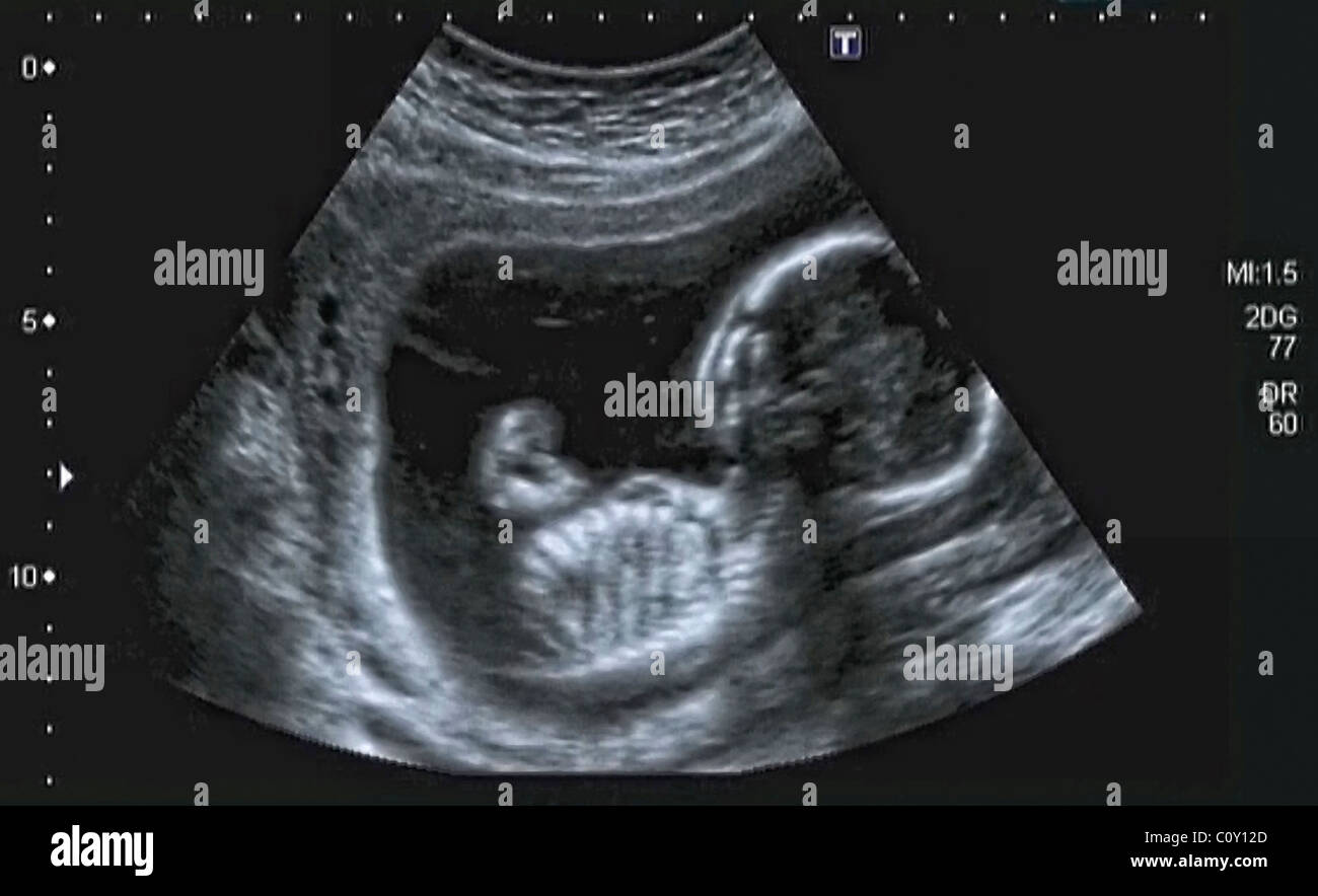 Echographie 4 Mois Kyle Carter Echographie 4 Mois Kyle Carter