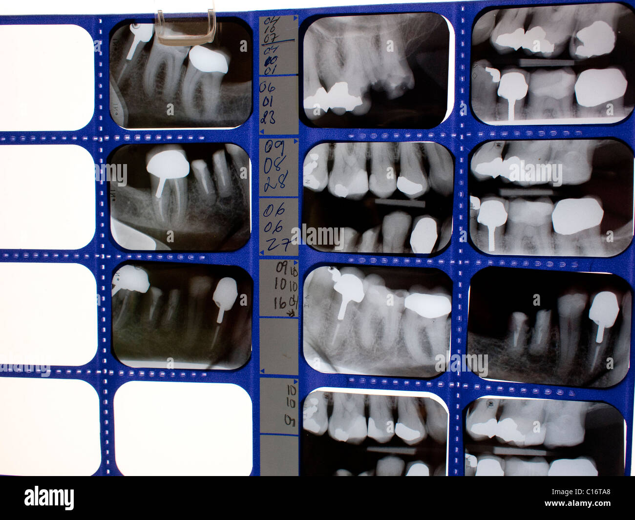 X-ray de patients les dents au dentiste Banque D'Images