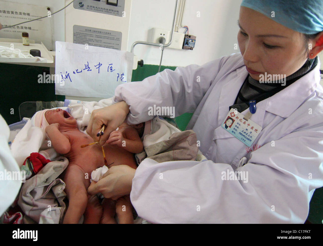 Chirurgiens pour séparer les jumeaux siamois deux jumeaux siamois sont tendrement nourris par leurs parents aimants, quelques jours avant une délicate Banque D'Images