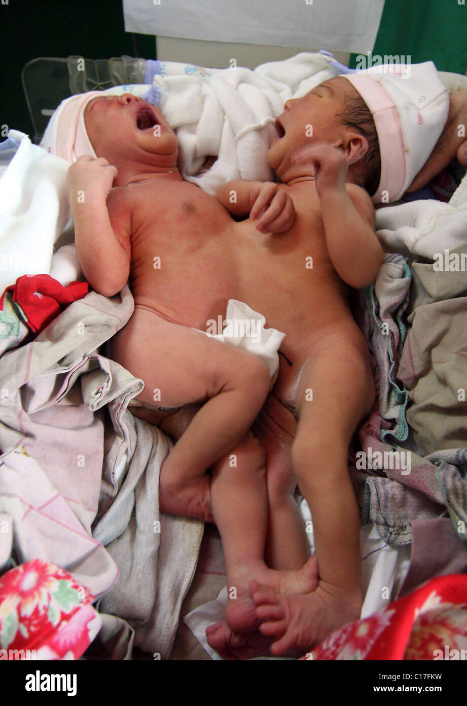 Chirurgiens pour séparer les jumeaux siamois deux jumeaux siamois sont tendrement nourris par leurs parents aimants, quelques jours avant une délicate Banque D'Images