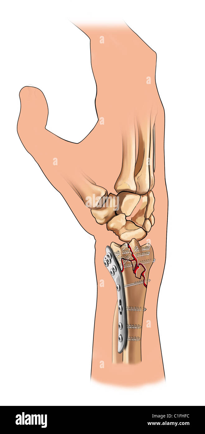 Plaque palmaire Banque de photographies et d’images à haute résolution