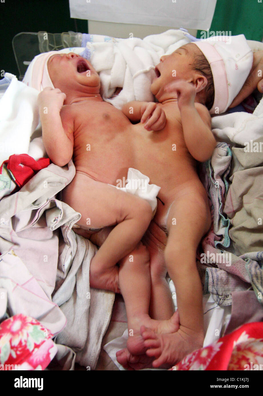 Jumeaux siamois sont enfin de retour en une paire de jumeaux siamois qui ont survécu à la chirurgie pour les séparer ont reçu leur congé de Banque D'Images