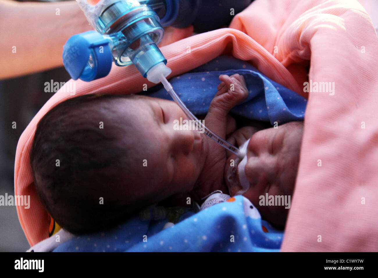 Soeurs siamoises séparation attendent les médecins se préparent pour séparer les jumeaux siamois après qu'ils sont nés prématurément en Amérique du Banque D'Images