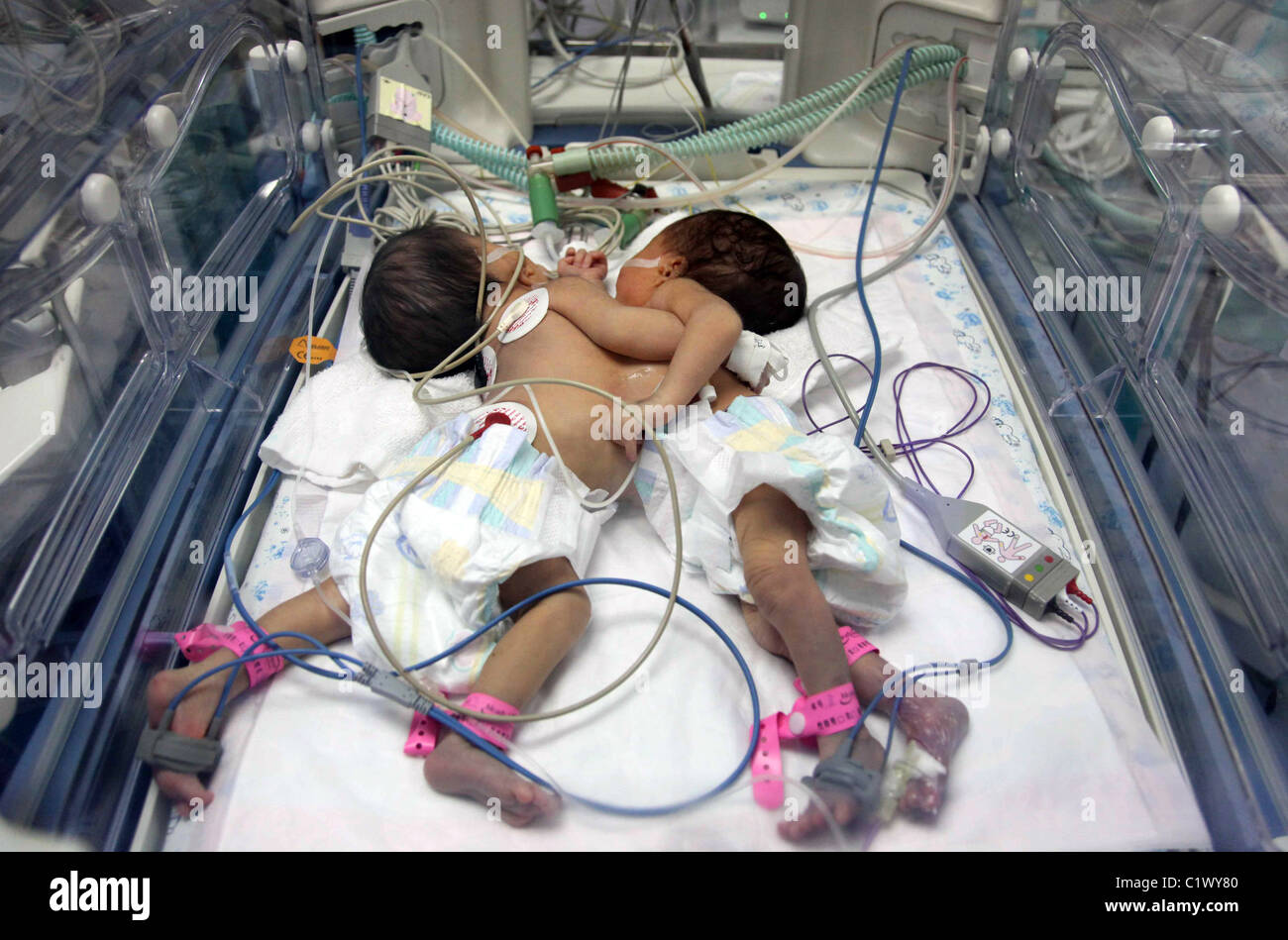 Soeurs siamoises séparation attendent les médecins se préparent pour séparer les jumeaux siamois après qu'ils sont nés prématurément en Amérique du Banque D'Images