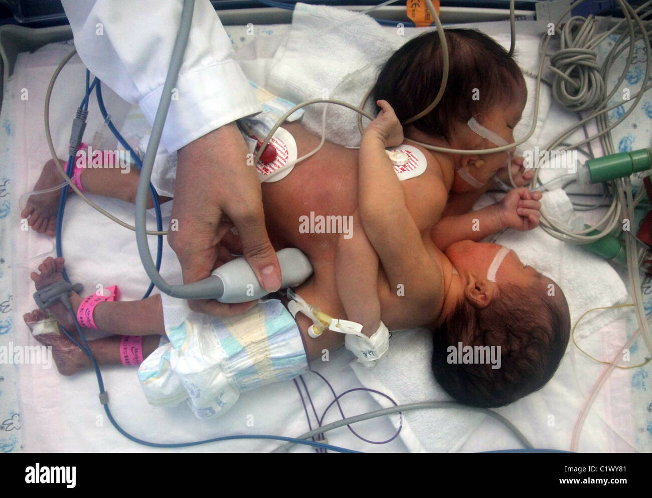 Soeurs siamoises séparation attendent les médecins se préparent pour séparer les jumeaux siamois après qu'ils sont nés prématurément en Amérique du Banque D'Images