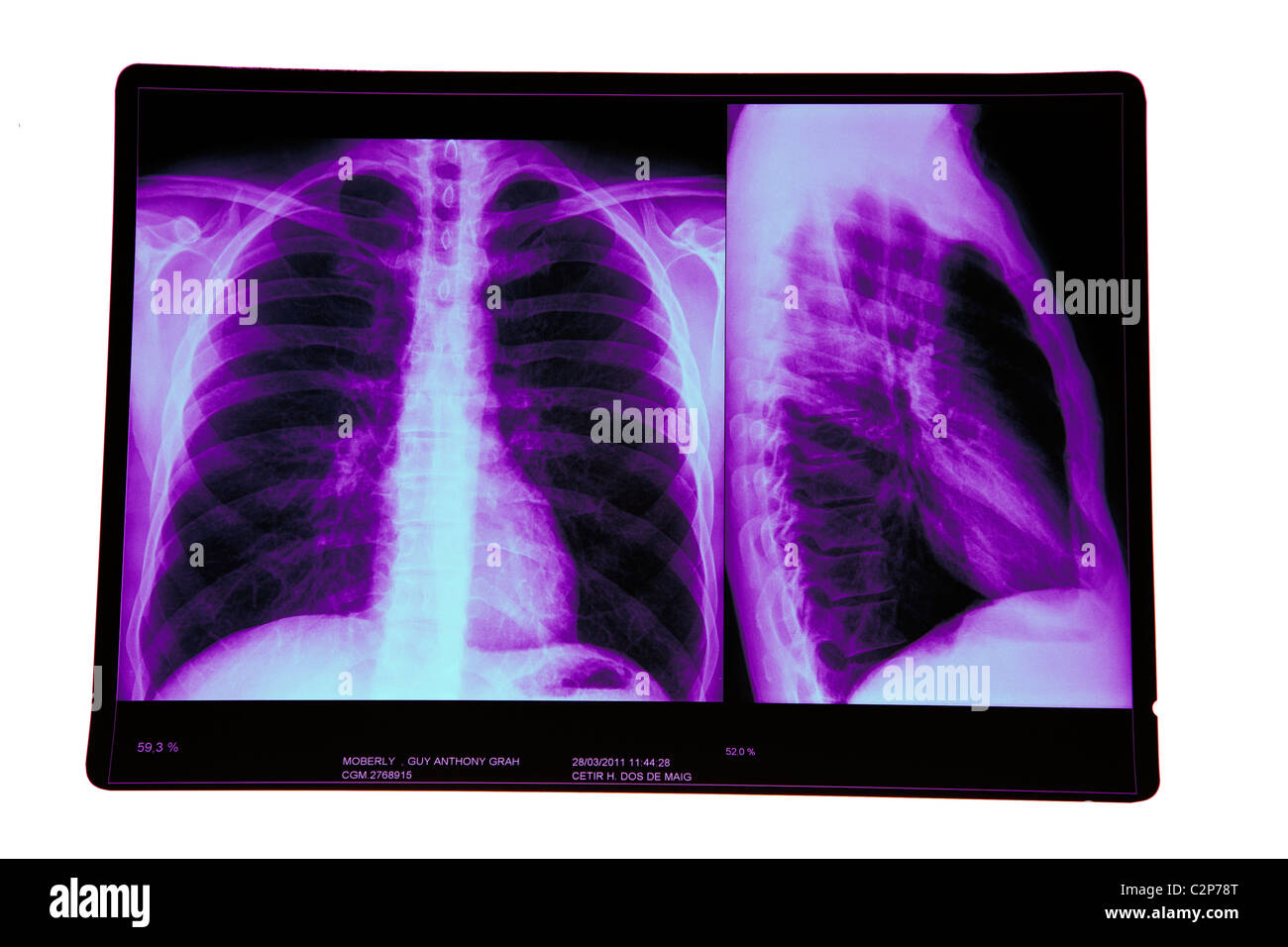 Radiographie des poumons Banque D'Images