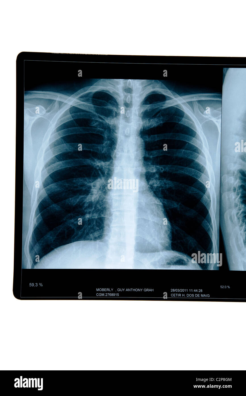 Radiographie des poumons Photo Stock - Alamy