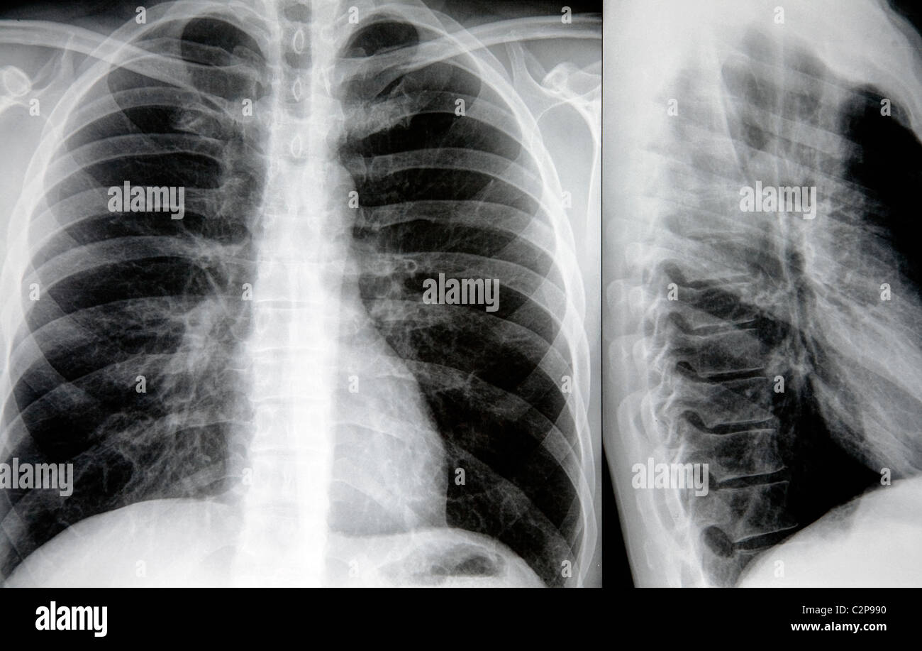 Radiographie des poumons Banque D'Images