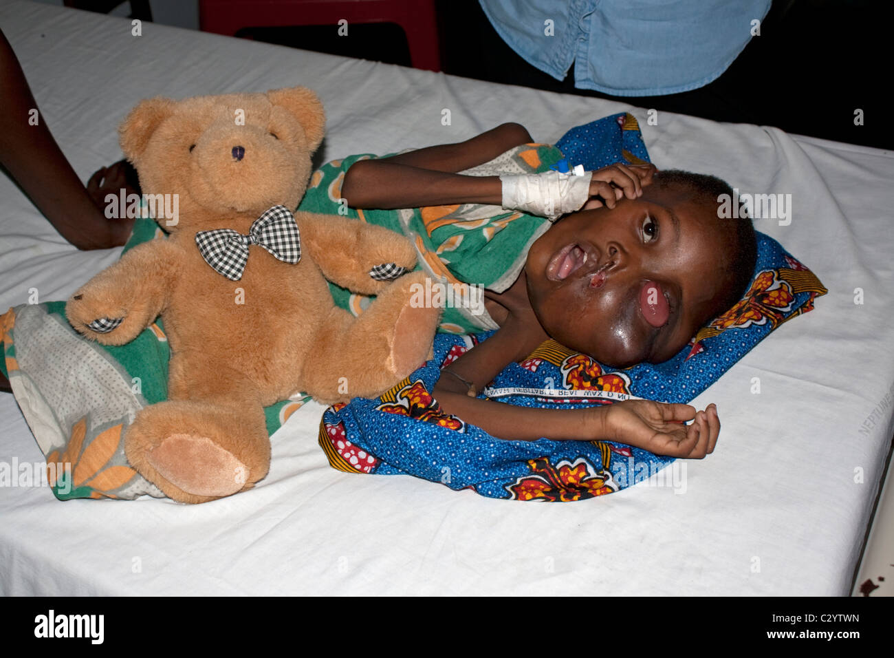 Jeune garçon africain avec de graves symptômes de cancer de l'hôpital Burkitts côte de Mombasa au Kenya Banque D'Images