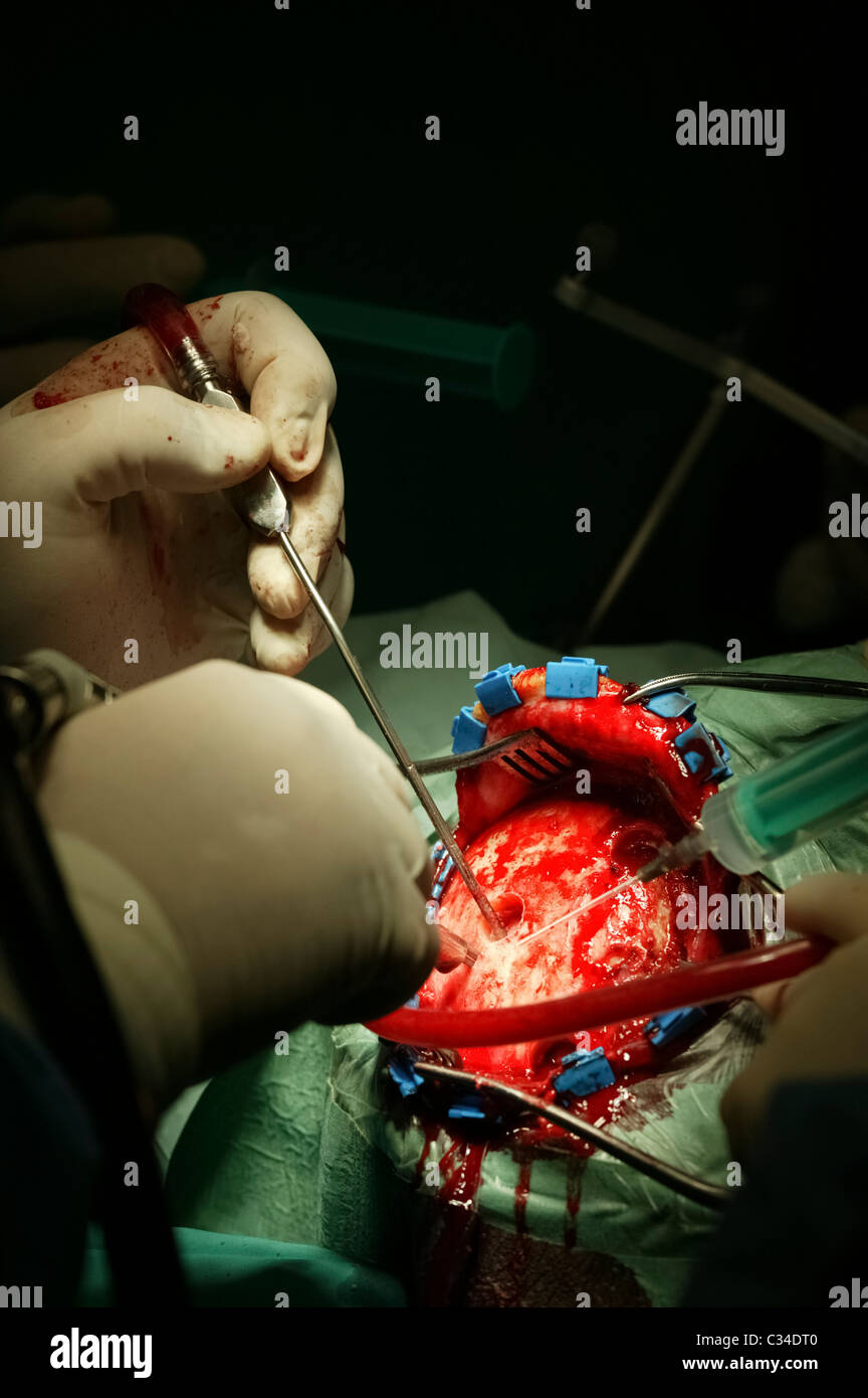 Une chirurgie du cerveau detail shot Banque D'Images