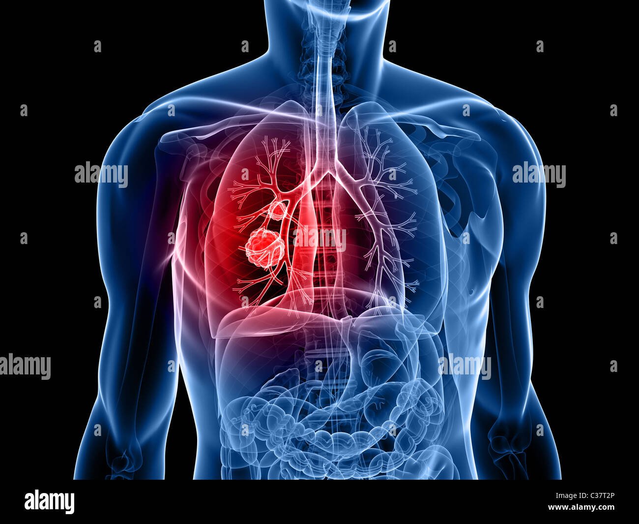 cancer du poumon Banque D'Images