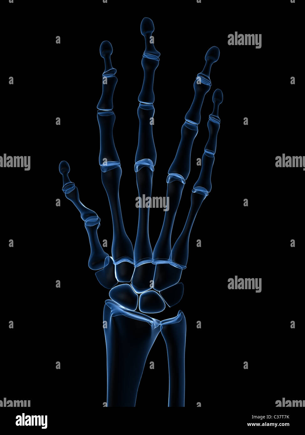 X-ray mains - arthrite Banque D'Images