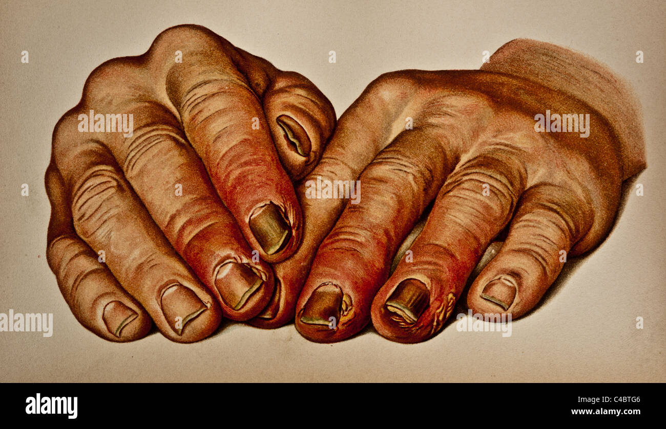 Paronychia Infection Banque D Image Et Photos Alamy