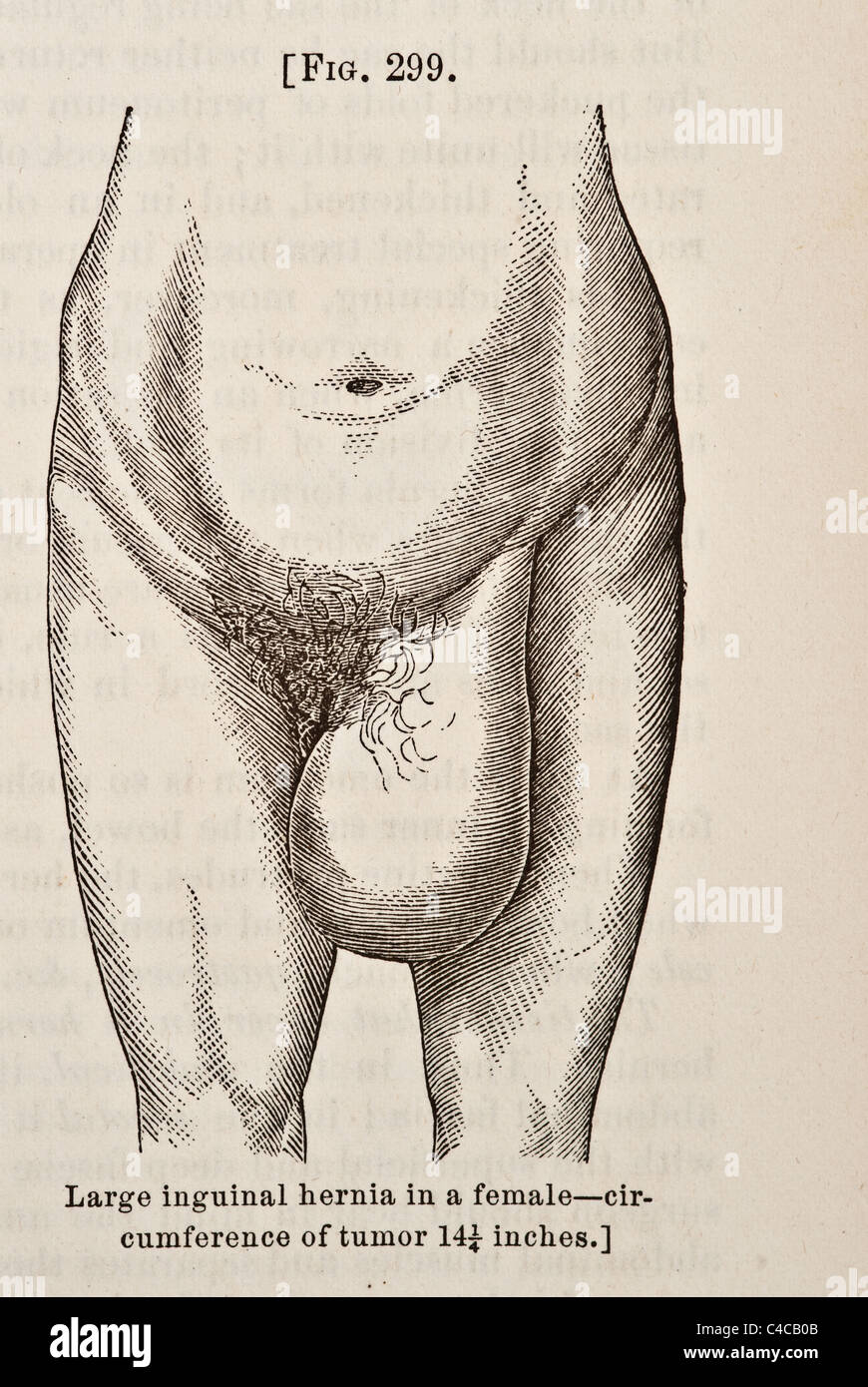Illustration médicale antique circa 1881 Hernie Banque D'Images