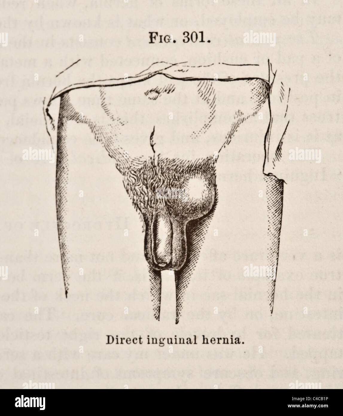 Illustration médicale antique circa 1881 Hernie Banque D'Images