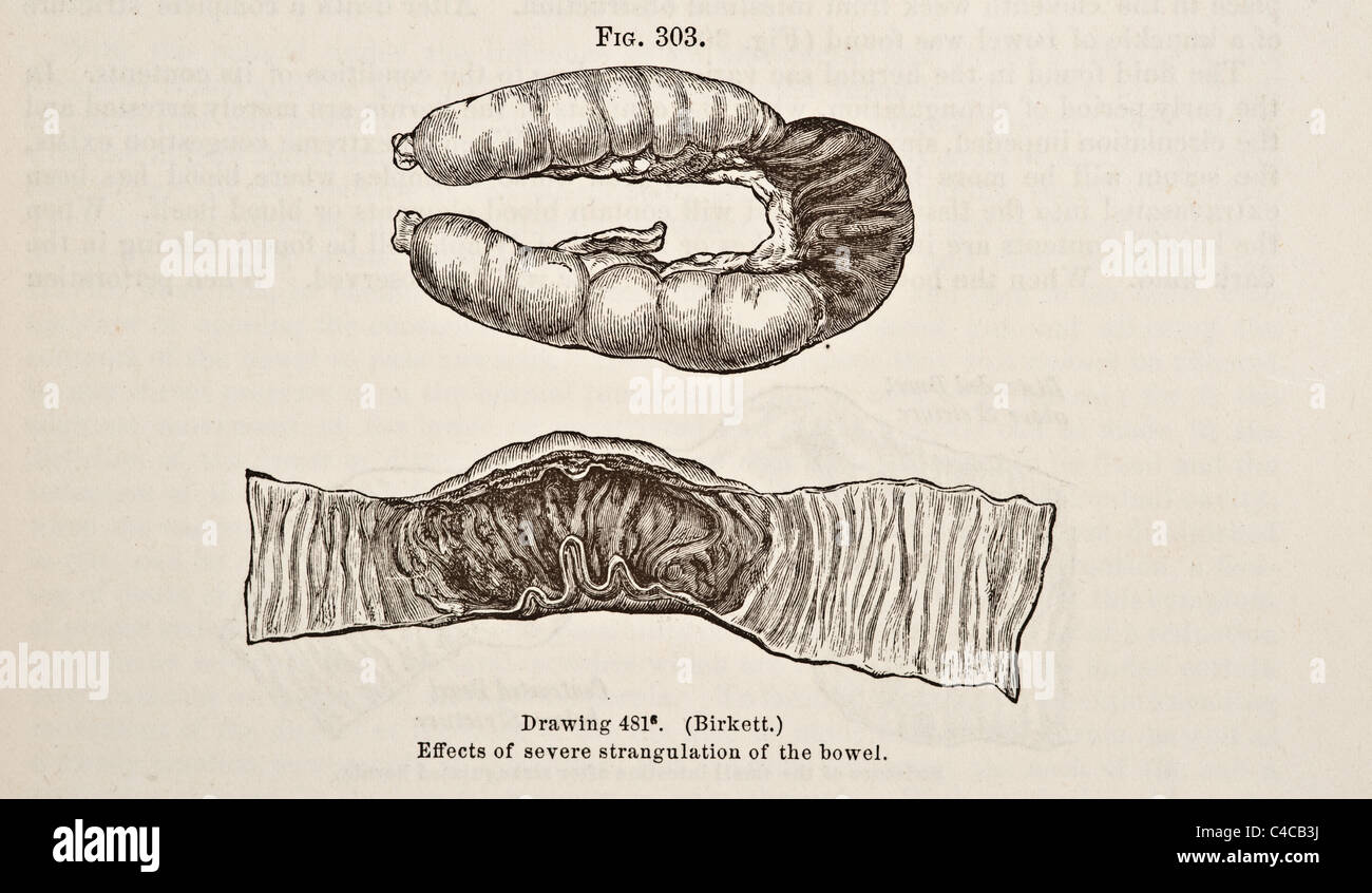 Illustration médicale antique circa 1881 Hernie Banque D'Images