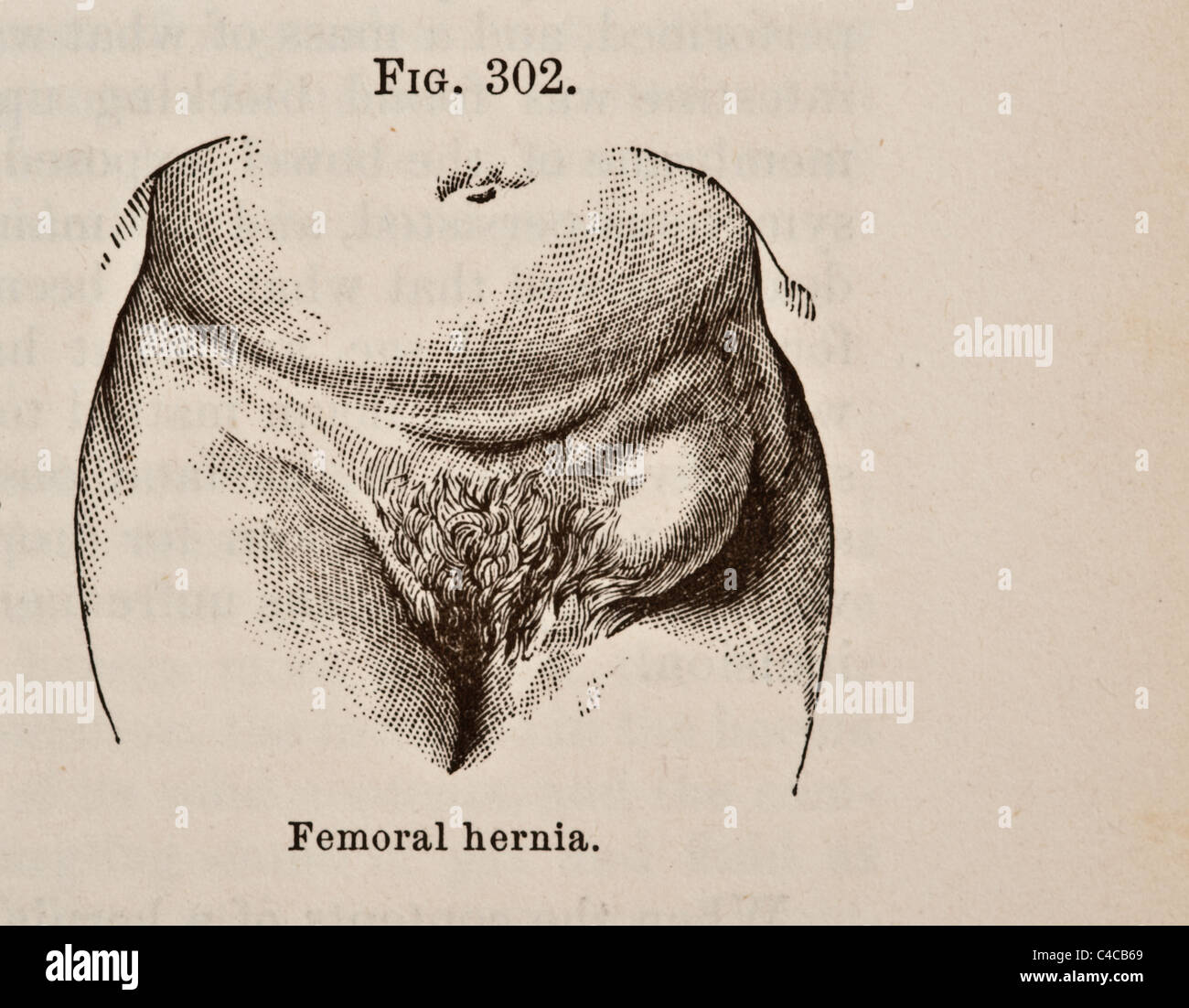 Illustration médicale antique circa 1881 Hernie Banque D'Images