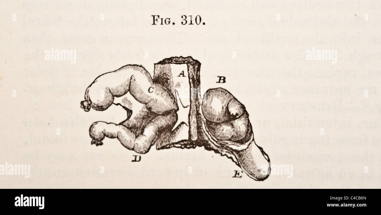 Illustration médicale antique circa 1881 Hernie Banque D'Images