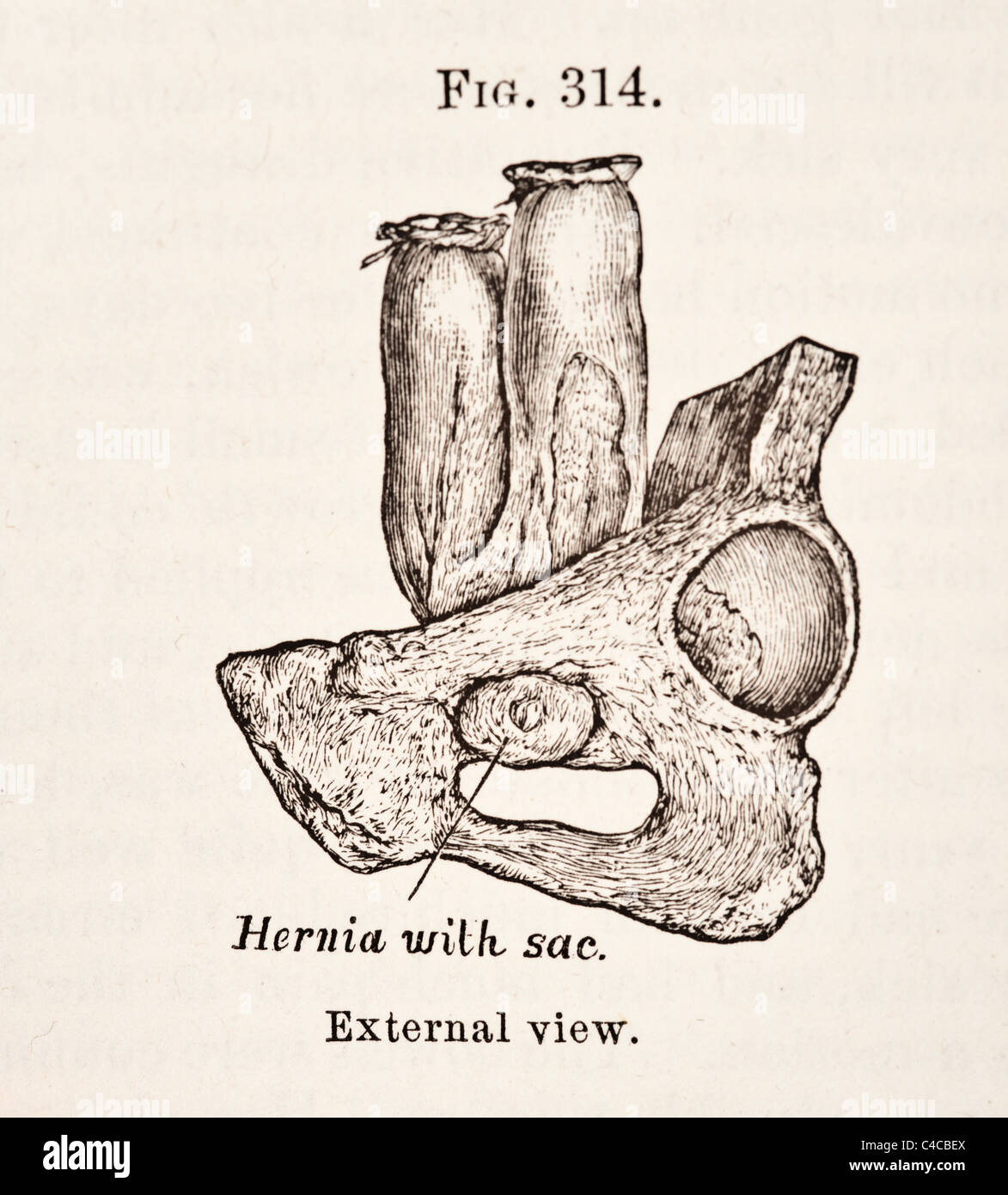 Illustration médicale antique circa 1881 Hernie Banque D'Images