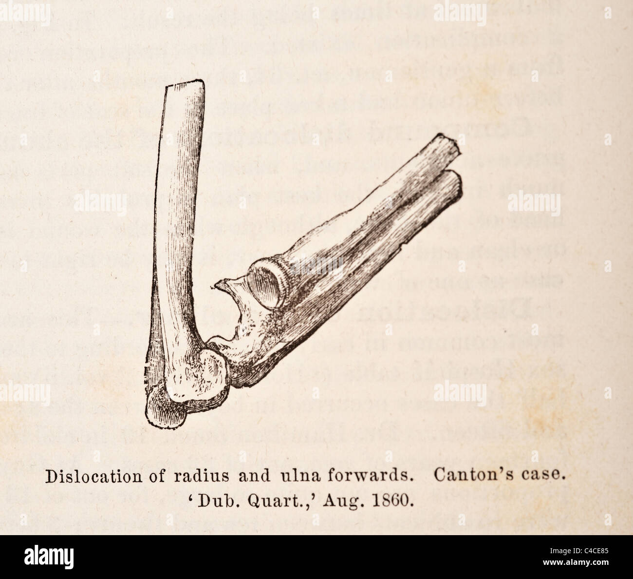 Illustration médicale antique de la dislocation du coude vers 1881 Banque D'Images
