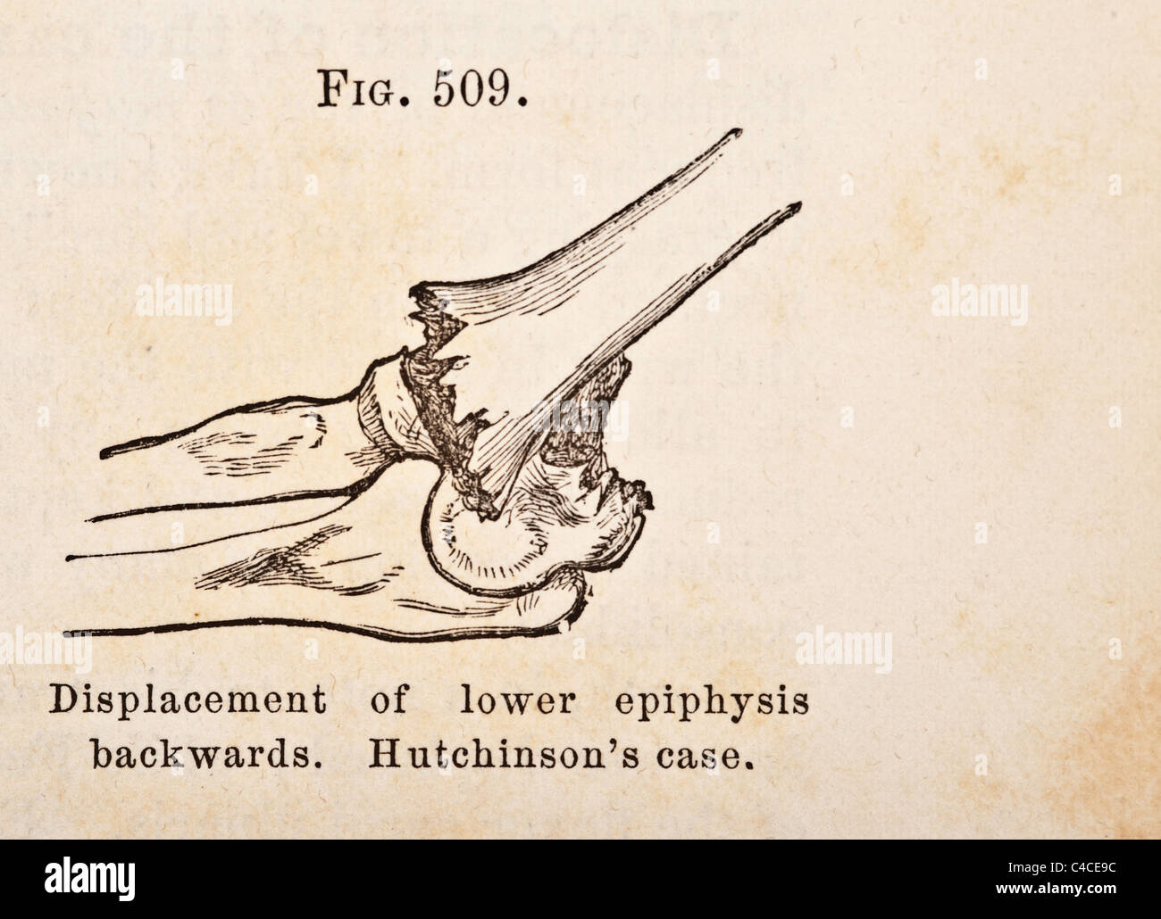 Illustration médicale antique de la dislocation du coude vers 1881 Banque D'Images