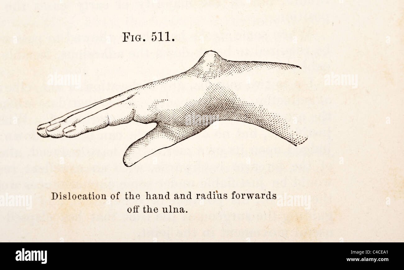 Illustration médicale antique des luxations du poignet vers 1881 Banque D'Images