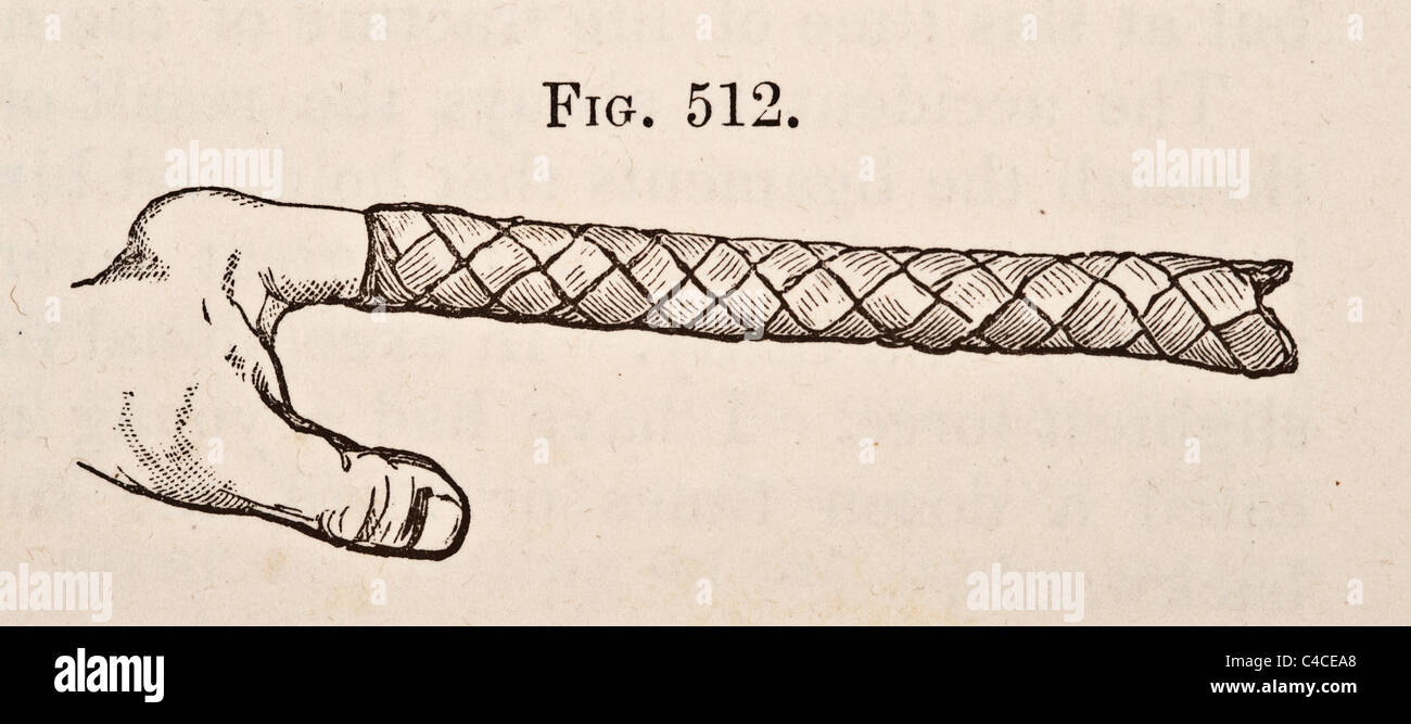 Illustration médicale antique des luxations du poignet vers 1881 Banque D'Images