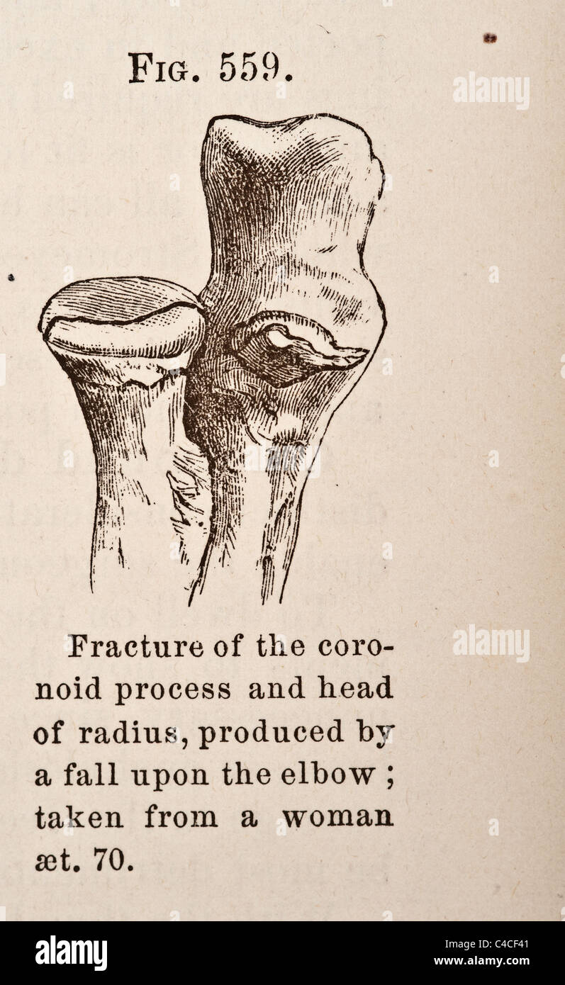 Illustration médicale antique de fractures du radius Banque D'Images