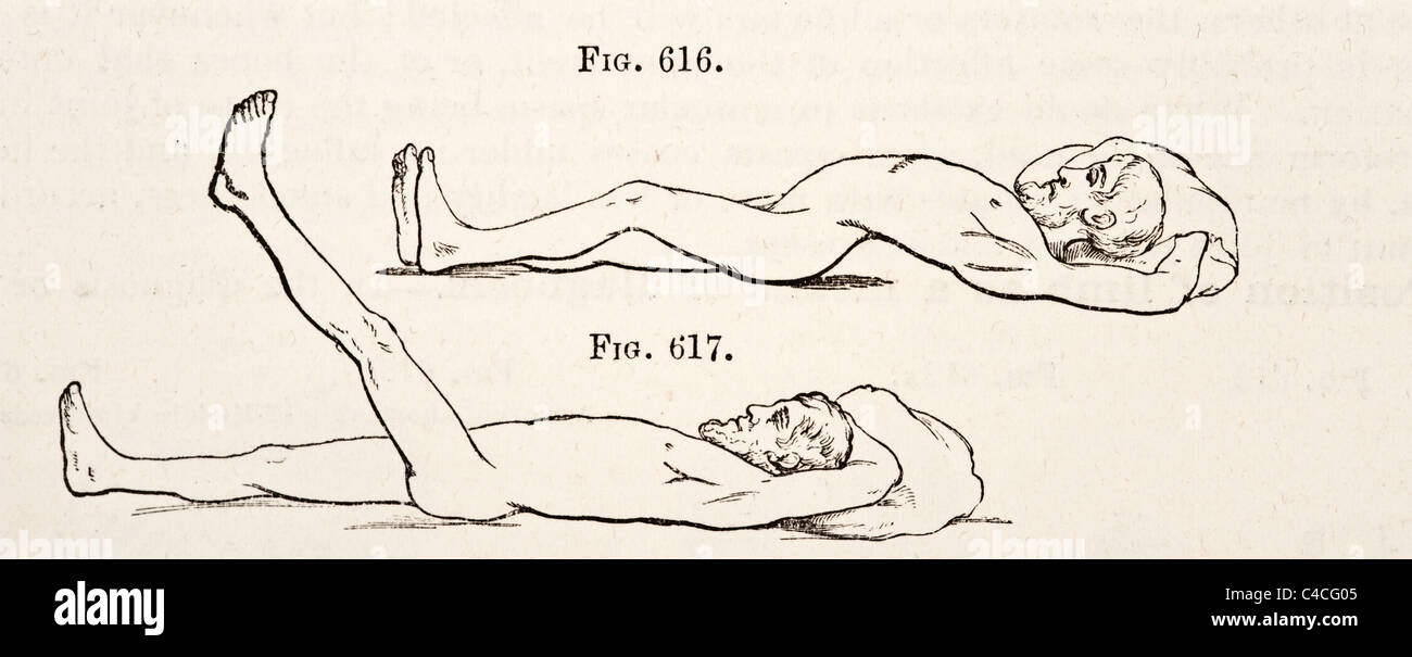 Illustration médicale antique d'Hip-Joint vers la maladie de la hanche 1881 Banque D'Images